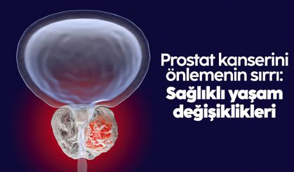 Prostat kanserini önlemenin sırrı: Sağlıklı yaşam değişiklikleri